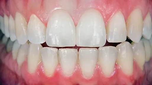 After cosmetic treatment